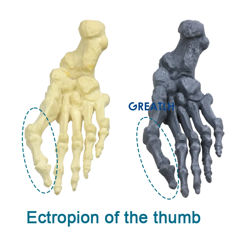 Два варианта тип Модел на човешкия скелет Модел эктропиона на палеца на Модел за корекция на деформация вальгусной